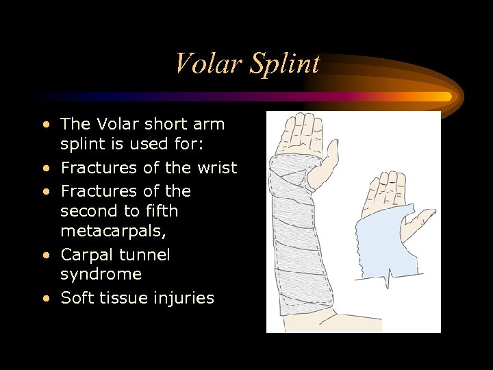 Volar Splint • The Volar short arm splint is used for: • Fractures of