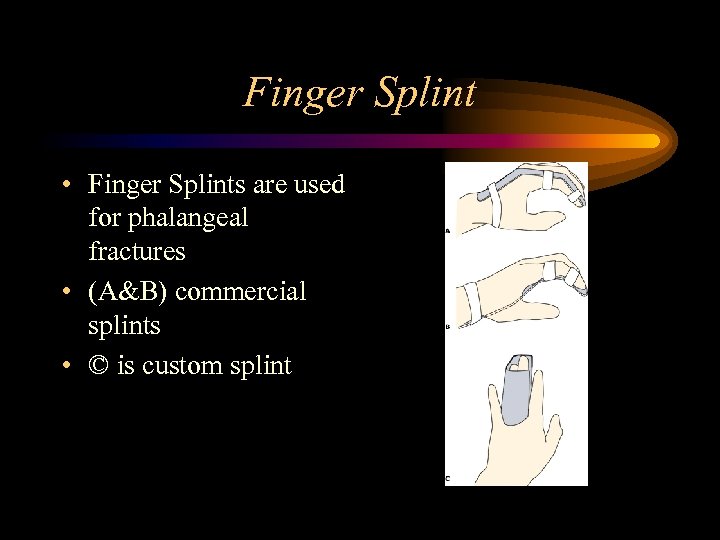 Finger Splint • Finger Splints are used for phalangeal fractures • (A&B) commercial splints