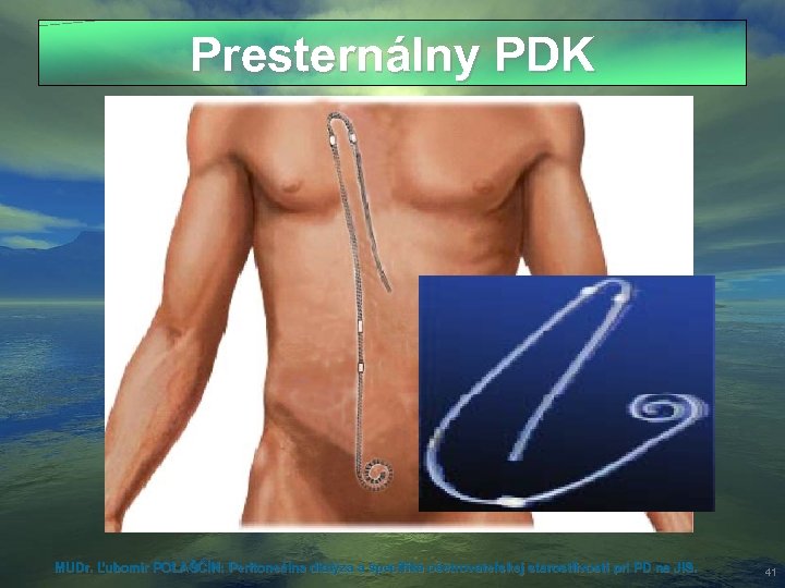 Presternálny PDK MUDr. Ľubomír POLAŠČÍN: Peritoneálna dialýza a špecifiká ošetrovateľskej starostlivosti pri PD na