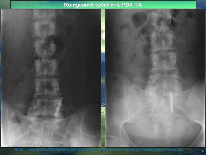Röntgenové vyšetrenia PDK 1/4 MUDr. Ľubomír POLAŠČÍN: Peritoneálna dialýza a špecifiká ošetrovateľskej starostlivosti pri