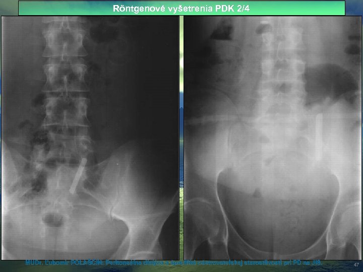 Röntgenové vyšetrenia PDK 2/4 MUDr. Ľubomír POLAŠČÍN: Peritoneálna dialýza a špecifiká ošetrovateľskej starostlivosti pri