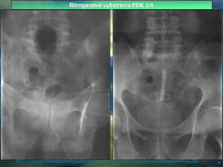 Röntgenové vyšetrenia PDK 3/4 MUDr. Ľubomír POLAŠČÍN: Peritoneálna dialýza a špecifiká ošetrovateľskej starostlivosti pri