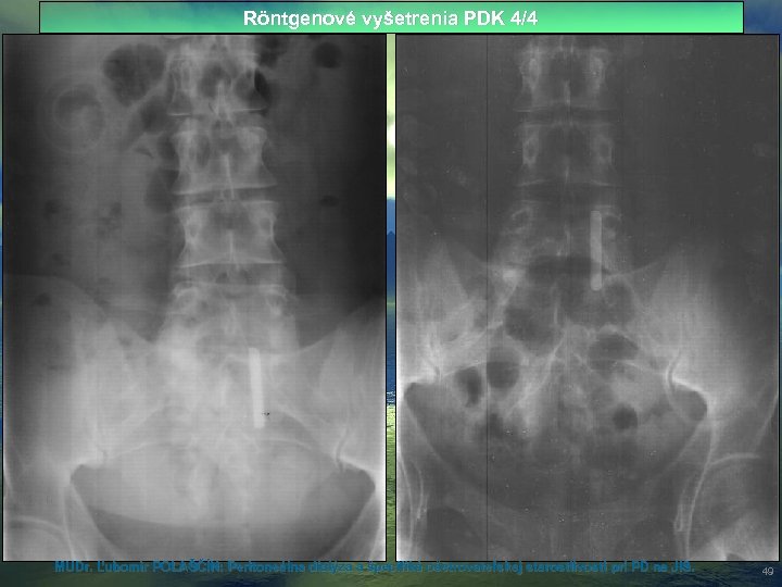 Röntgenové vyšetrenia PDK 4/4 MUDr. Ľubomír POLAŠČÍN: Peritoneálna dialýza a špecifiká ošetrovateľskej starostlivosti pri
