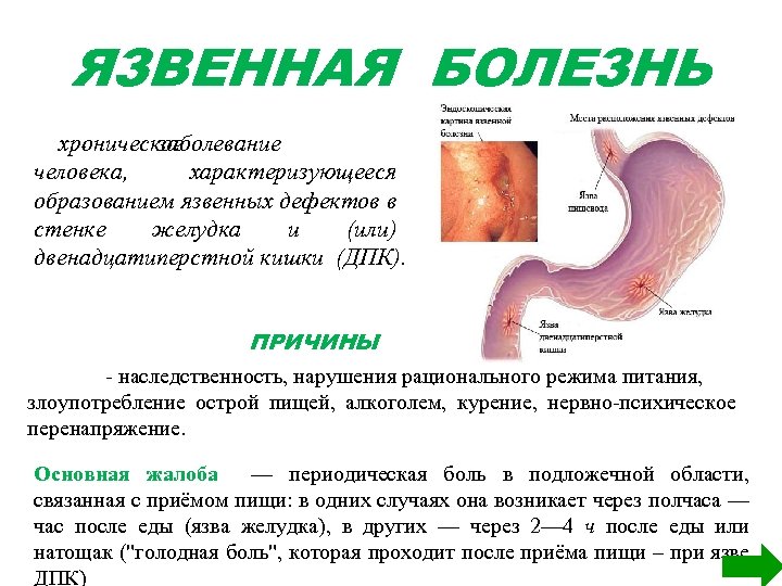 ЯЗВЕННАЯ БОЛЕЗНЬ хроническое заболевание человека, характеризующееся образованием язвенных дефектов в стенке желудка и (или)