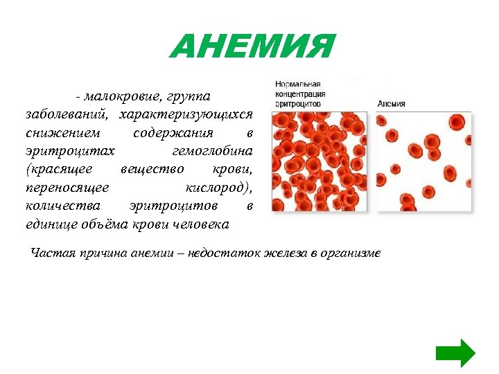 АНЕМИЯ - малокровие, группа заболеваний, характеризующихся снижением содержания в эритроцитах гемоглобина (красящее вещество крови,