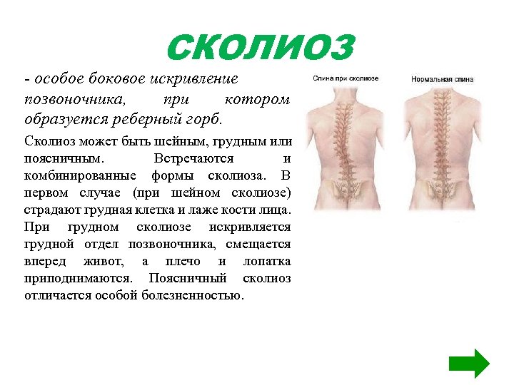 СКОЛИОЗ - особое боковое искривление позвоночника, при котором образуется реберный горб. Сколиоз может быть