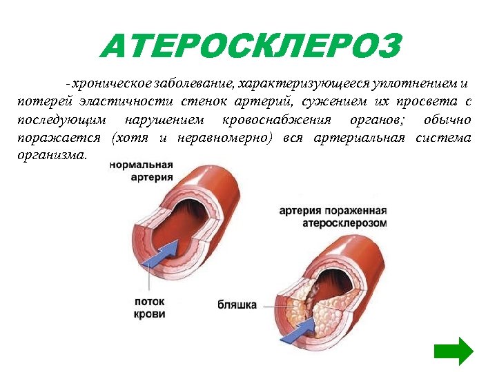 АТЕРОСКЛЕРОЗ - хроническое заболевание, характеризующееся уплотнением и потерей эластичности стенок артерий, сужением их просвета