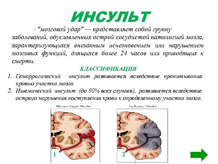 ИНСУЛЬТ - "мозговой удар" — представляет собой группу заболеваний, обусловленных острой сосудистой патологией мозга,