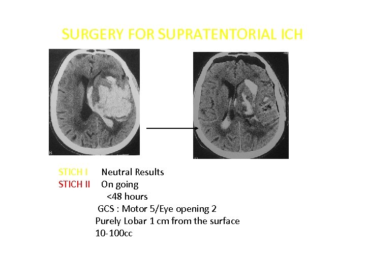 SURGERY FOR SUPRATENTORIAL ICH STICH II Neutral Results On going <48 hours GCS :