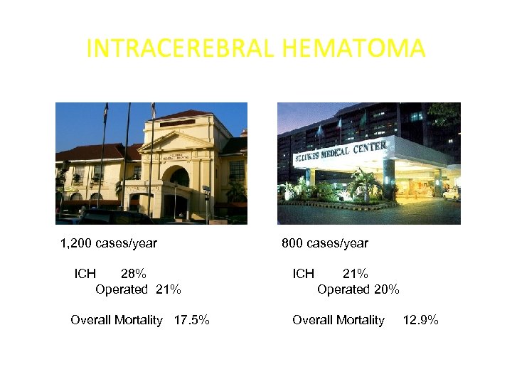 INTRACEREBRAL HEMATOMA 1, 200 cases/year 800 cases/year ICH 28% Operated 21% ICH 21% Operated