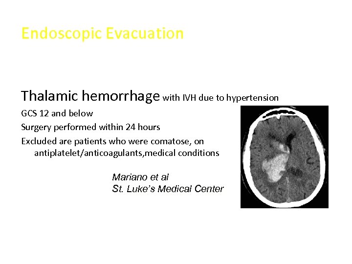 Endoscopic Evacuation • Selection criteria Thalamic hemorrhage with IVH due to hypertension GCS 12