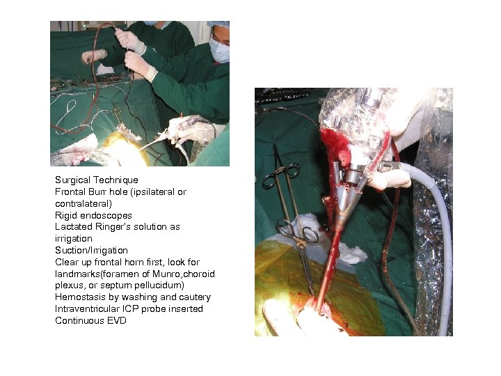 Surgical Technique Frontal Burr hole (ipsilateral or contralateral) Rigid endoscopes Lactated Ringer’s solution as