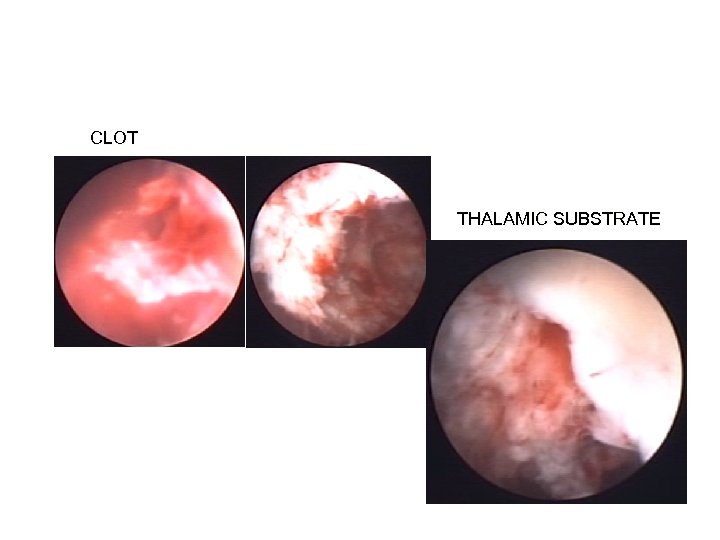CLOT THALAMIC SUBSTRATE 
