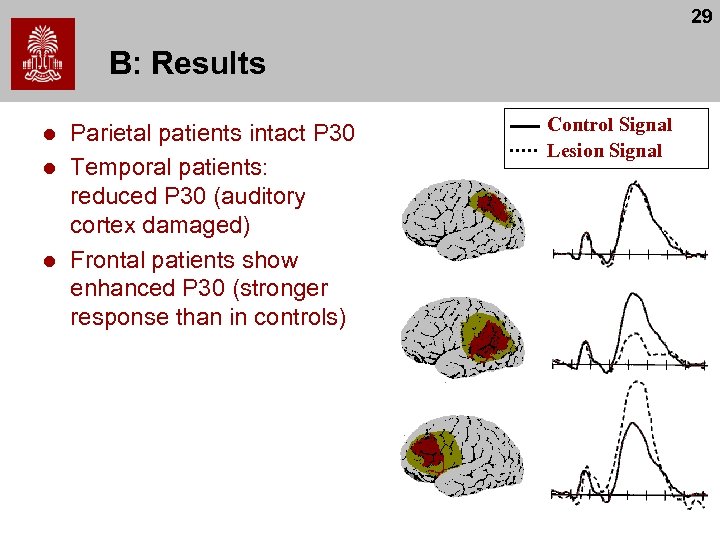 29 B: Results l l l Parietal patients intact P 30 Temporal patients: reduced