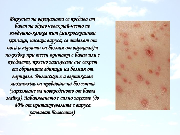 Вирусът на варицелата се предава от болен на здрав човек най-често по въздушно-капков път