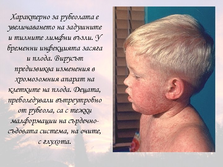 Характерно за рубеолата е увеличаването на задушните и тилните лимфни възли. У бременни инфекцията