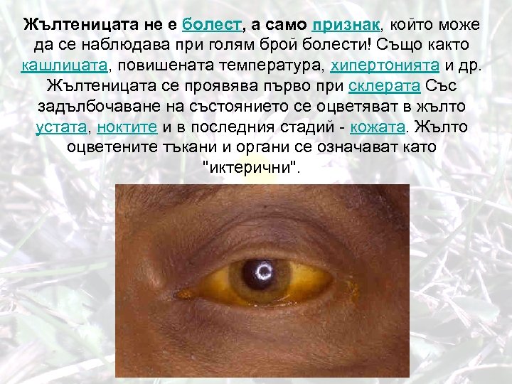Жълтеницата не е болест, а само признак, който може да се наблюдава при голям