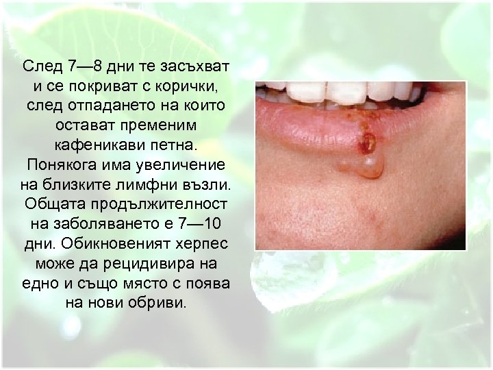 След 7— 8 дни те засъхват и се покриват с корички, след отпадането на