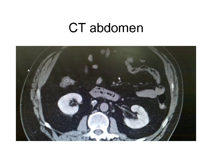 CT abdomen 