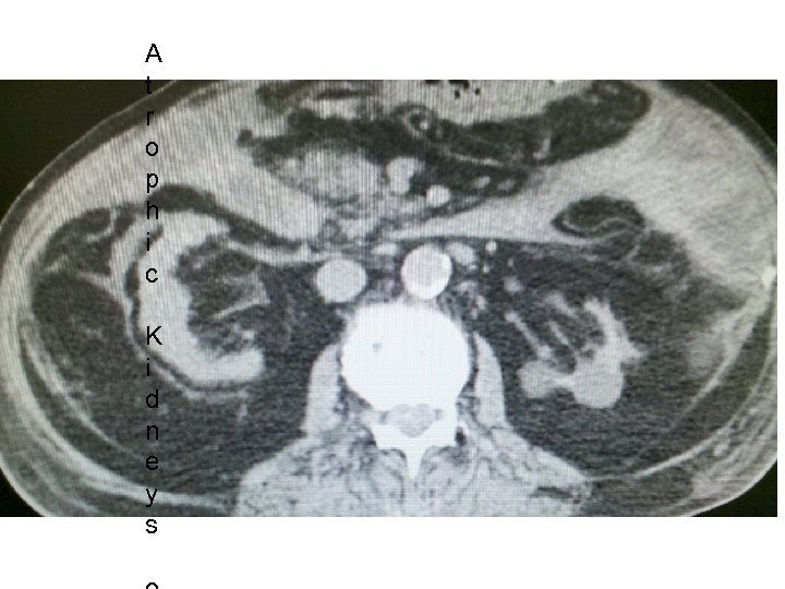 A t r o p h i c K i d n e y