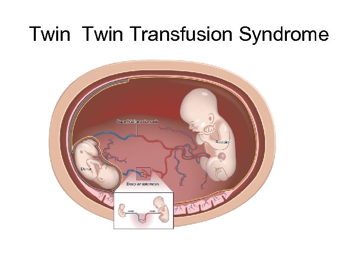 Twin Transfusion Syndrome 