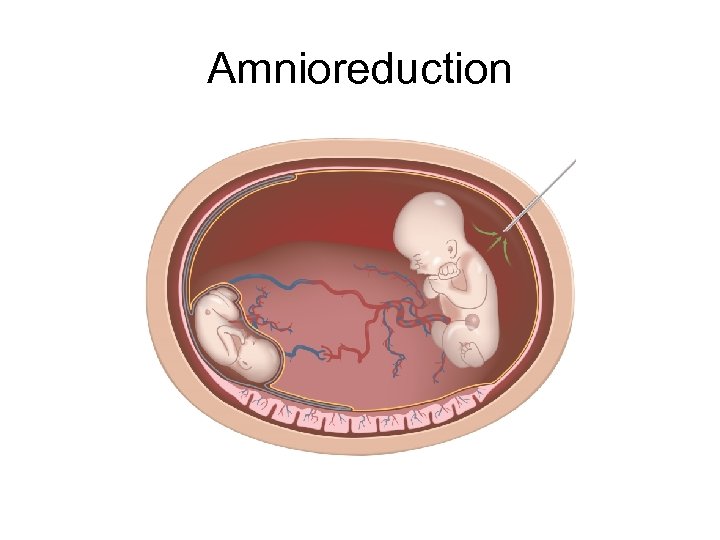 Amnioreduction 