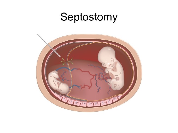 Septostomy 