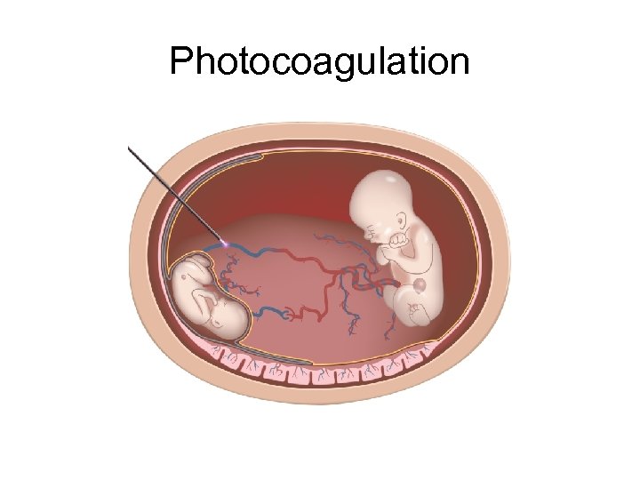 Photocoagulation 