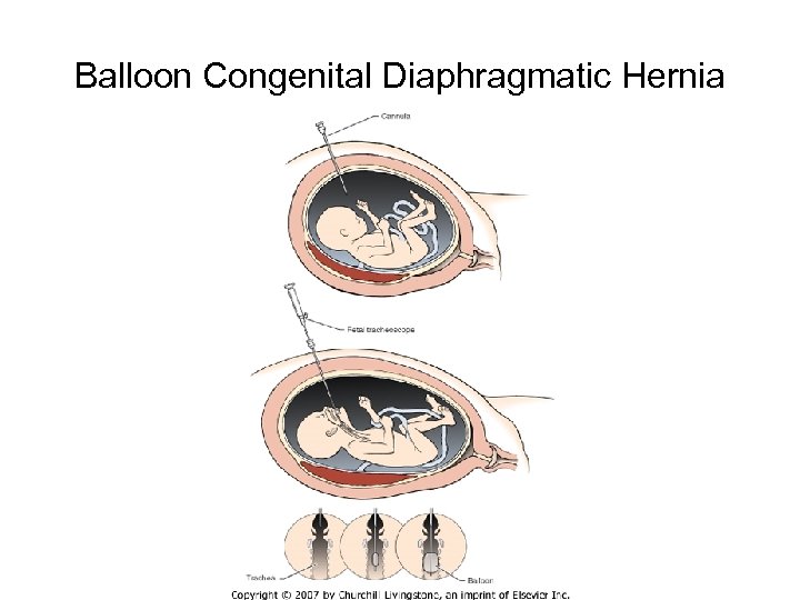 Balloon Congenital Diaphragmatic Hernia 