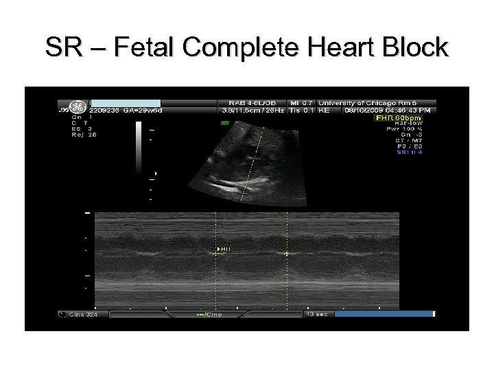 SR – Fetal Complete Heart Block 