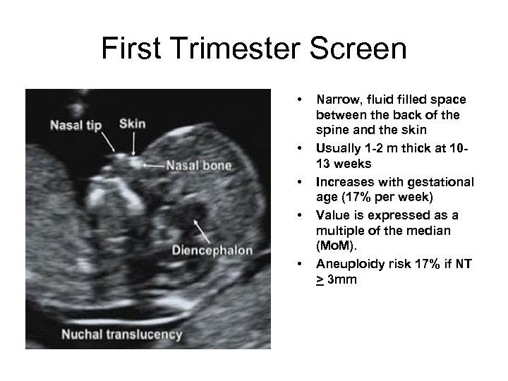 First Trimester Screen • • • Narrow, fluid filled space between the back of