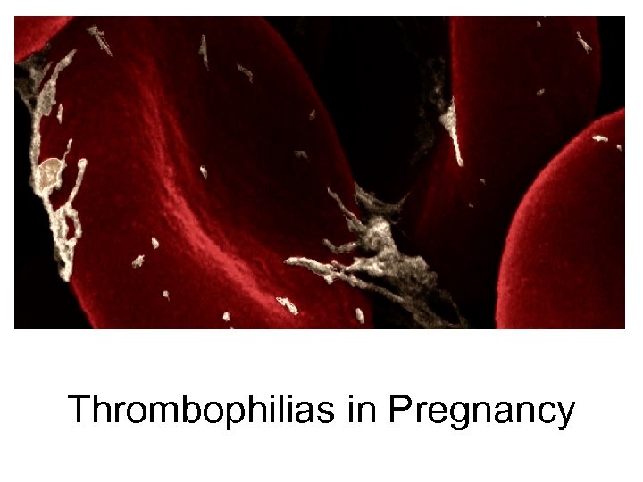 Thrombophilias in Pregnancy 