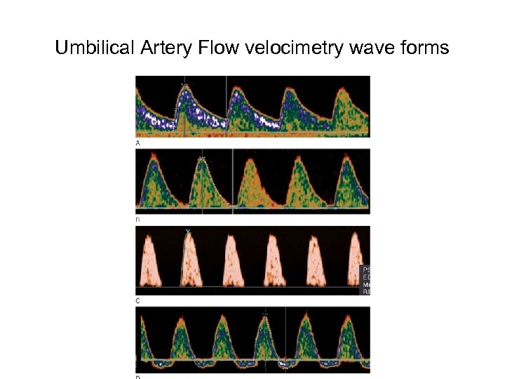 Umbilical Artery Flow velocimetry wave forms 