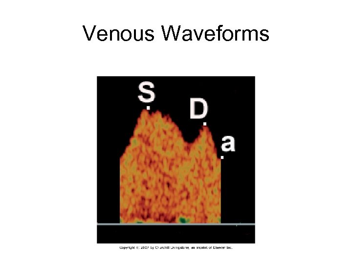 Venous Waveforms 