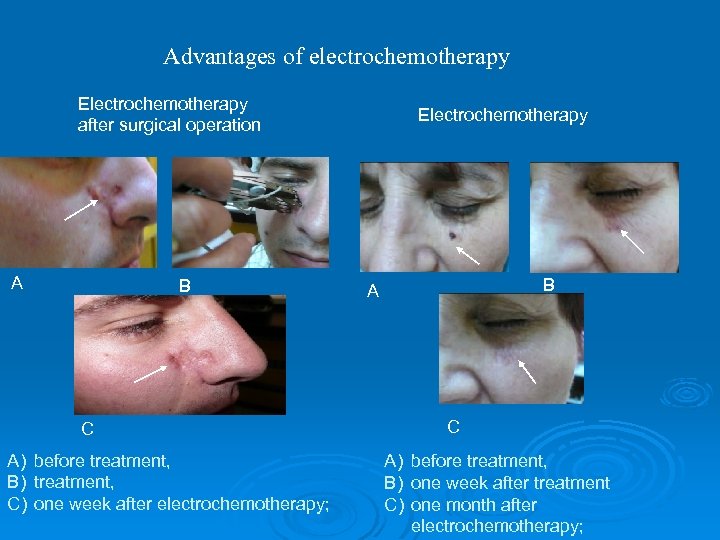 Advantages of electrochemotherapy Electrochemotherapy after surgical operation A B C A) before treatment, B)