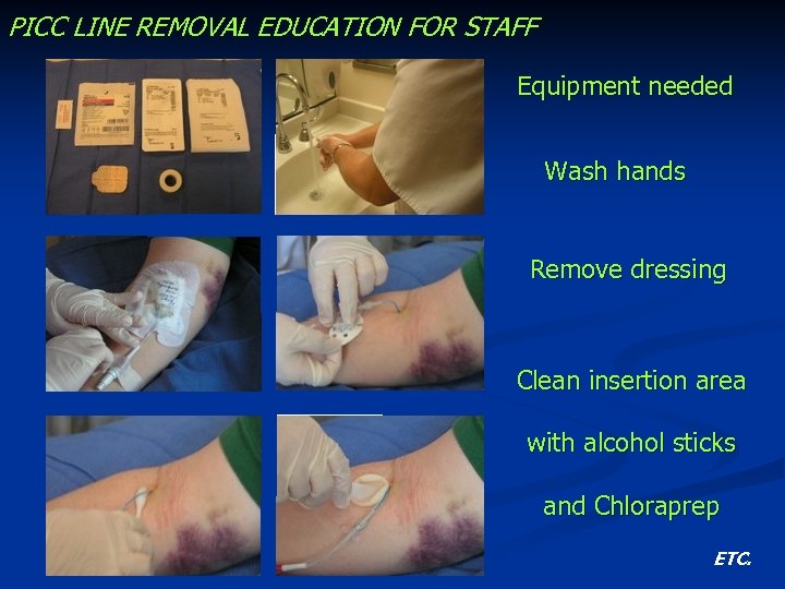 PICC LINE REMOVAL EDUCATION FOR STAFF Equipment needed Wash hands Remove dressing Clean insertion