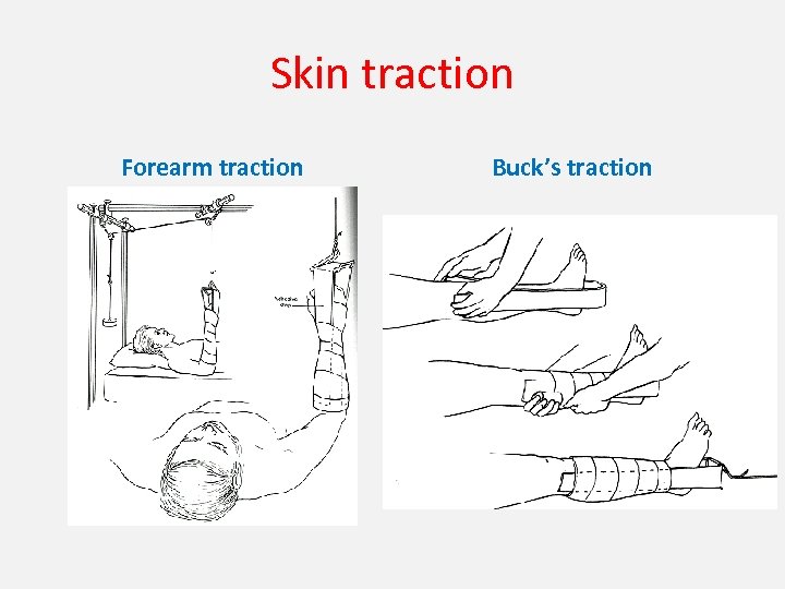 Skin traction Forearm traction Buck’s traction 