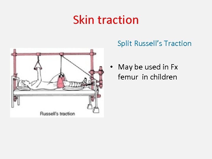 Skin traction Split Russell’s Traction • May be used in Fx femur in children