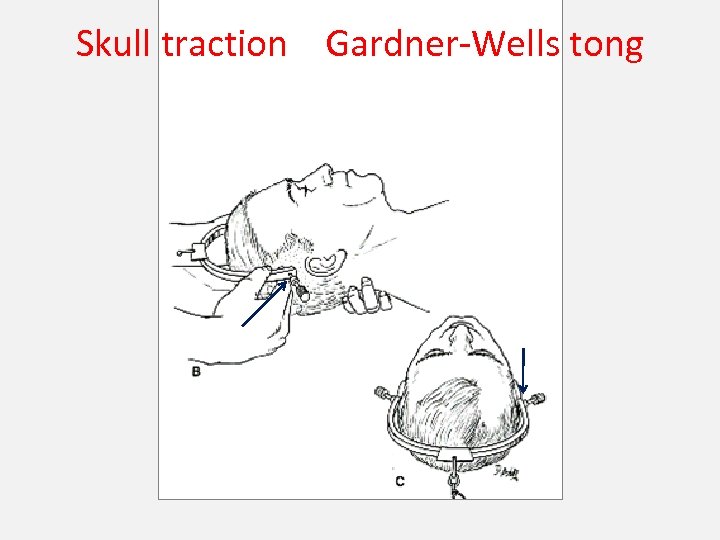 Skull traction Gardner-Wells tong 