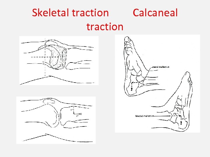 Skeletal traction Calcaneal traction 