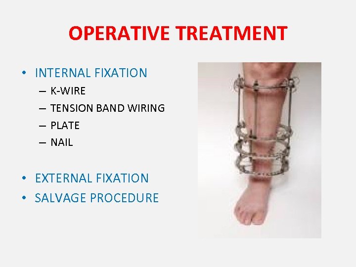 OPERATIVE TREATMENT • INTERNAL FIXATION – – K-WIRE TENSION BAND WIRING PLATE NAIL •