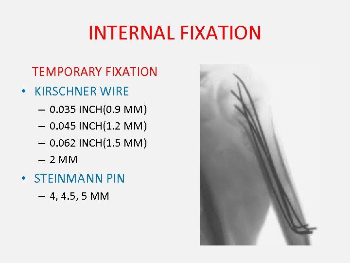 INTERNAL FIXATION TEMPORARY FIXATION • KIRSCHNER WIRE – – 0. 035 INCH(0. 9 MM)