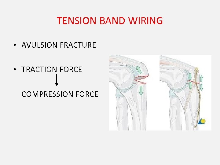 TENSION BAND WIRING • AVULSION FRACTURE • TRACTION FORCE COMPRESSION FORCE 