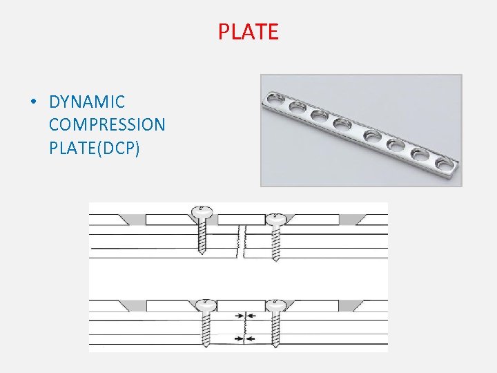 PLATE • DYNAMIC COMPRESSION PLATE(DCP) 