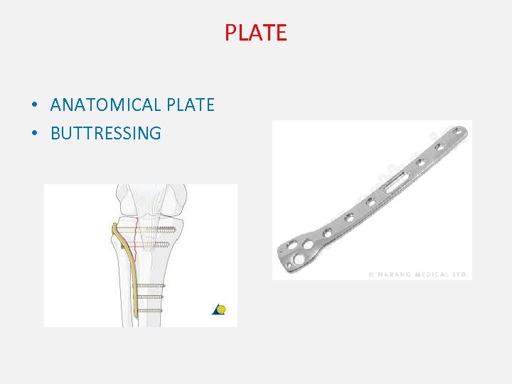 PLATE • ANATOMICAL PLATE • BUTTRESSING 