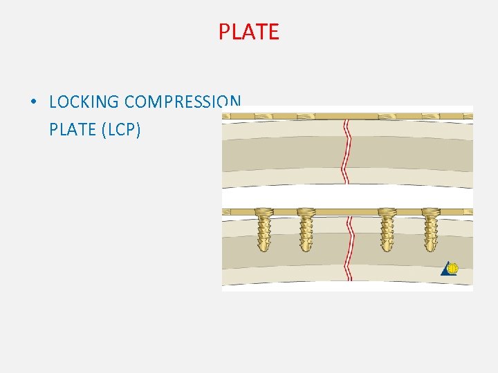 PLATE • LOCKING COMPRESSION PLATE (LCP) 