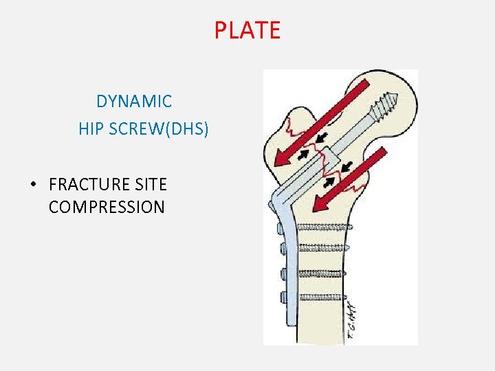 PLATE DYNAMIC HIP SCREW(DHS) • FRACTURE SITE COMPRESSION 