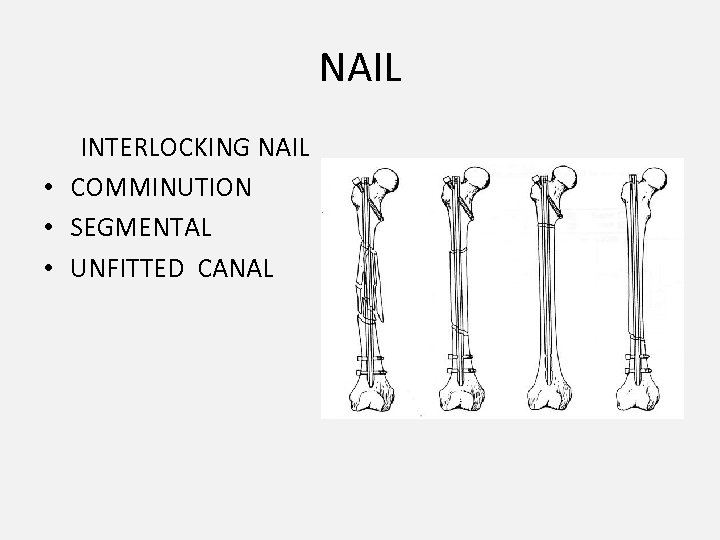 NAIL INTERLOCKING NAIL • COMMINUTION • SEGMENTAL • UNFITTED CANAL 