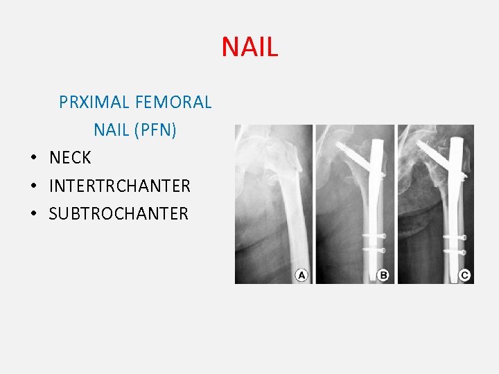 NAIL PRXIMAL FEMORAL NAIL (PFN) • NECK • INTERTRCHANTER • SUBTROCHANTER 