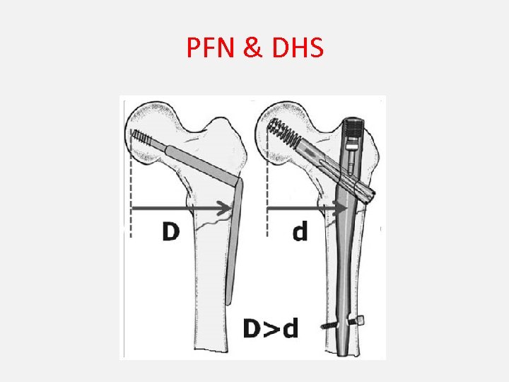 PFN & DHS 